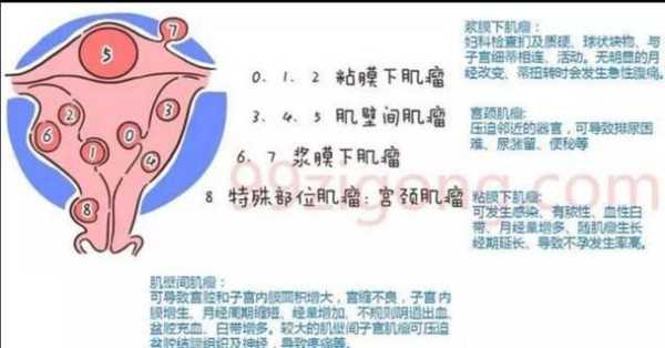 孕期肌瘤疼(孕期肌瘤疼痛多久会缓解) 第1张 孕期肌瘤疼(孕期肌瘤疼痛多久会缓解) 第1张