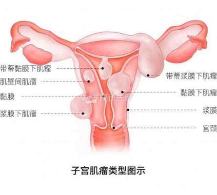 孕期肌瘤疼(孕期肌瘤疼痛多久会缓解) 第2张 孕期肌瘤疼(孕期肌瘤疼痛多久会缓解) 第2张