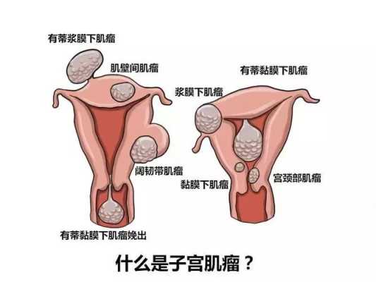 孕期肌瘤疼(孕期肌瘤疼痛多久会缓解) 第3张 孕期肌瘤疼(孕期肌瘤疼痛多久会缓解) 第3张