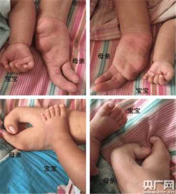 胎儿四肢短小该怎么办啊,胎儿手脚畸形是什么原因导致的 第1张 胎儿四肢短小该怎么办啊,胎儿手脚畸形是什么原因导致的 第1张