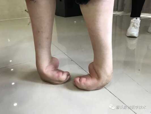 胎儿四肢短小该怎么办啊,胎儿手脚畸形是什么原因导致的 第2张 胎儿四肢短小该怎么办啊,胎儿手脚畸形是什么原因导致的 第2张