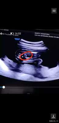 男婴比女婴股骨短吗,胎儿腿骨短怎么办 第3张 男婴比女婴股骨短吗,胎儿腿骨短怎么办 第3张