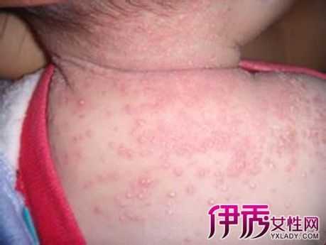 胎儿胎毒(胎儿胎毒) 第2张 胎儿胎毒(胎儿胎毒) 第2张
