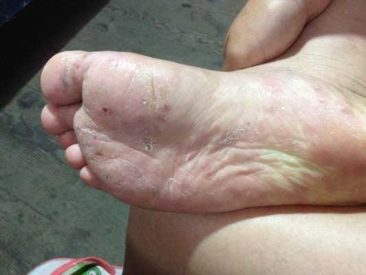 孕期脚底长水泡很痒（孕期脚底长水泡很痒,会影响孩子吗）  第1张