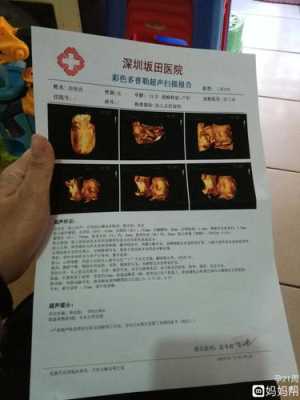 孕期四维彩超做几次（孕期四维彩超做几次合适）  第1张