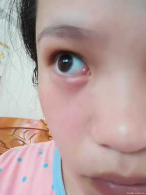 孕妇眼睛肿怎么办,孕期肿胀怎么缓解 第3张 孕妇眼睛肿怎么办,孕期肿胀怎么缓解 第3张