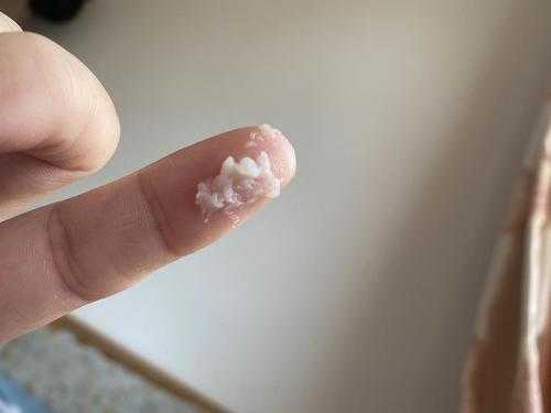 孕期霉菌怎么引起的(什么是霉菌呀?医生说同事怀孕得霉菌了,怀孕得霉菌怎么办) 第3张 孕期霉菌怎么引起的(什么是霉菌呀?医生说同事怀孕得霉菌了,怀孕得霉菌怎么办) 第3张