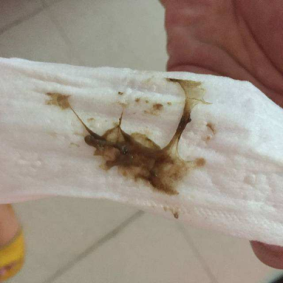 孕期褐色分泌物的图片（有褐色血说明胚胎已经生化吗）  第1张