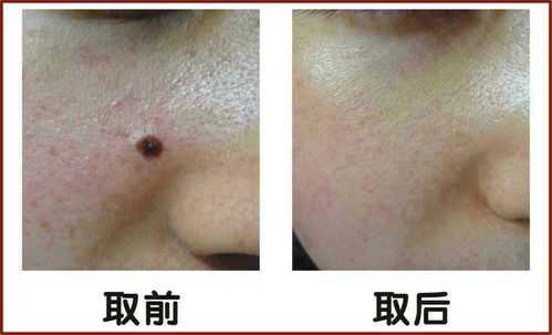 怀孕期间能点痣吗(怀孕期间能点痣吗有影响吗) 第2张 怀孕期间能点痣吗(怀孕期间能点痣吗有影响吗) 第2张