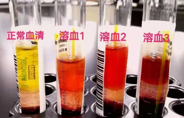 做胎儿溶血检查必须父母都去吗,孕期查溶血多少钱 第1张 做胎儿溶血检查必须父母都去吗,孕期查溶血多少钱 第1张