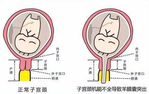 26周宫颈管26mm是不是太短了需要保胎吗,胎儿26mm是多大 第2张 26周宫颈管26mm是不是太短了需要保胎吗,胎儿26mm是多大 第2张