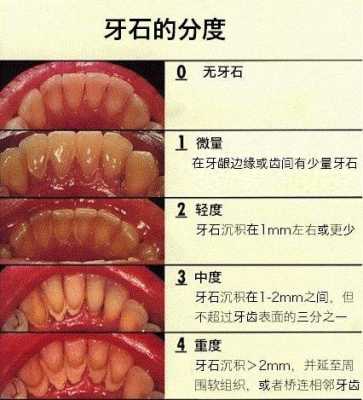 孕期牙酸(孕9周2天。每天都吐酸水,吐到牙酸倒。怎么回事) 第3张 孕期牙酸(孕9周2天。每天都吐酸水,吐到牙酸倒。怎么回事) 第3张