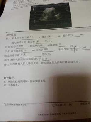 孕期39周(孕39周羊水偏多) 第3张 孕期39周(孕39周羊水偏多) 第3张
