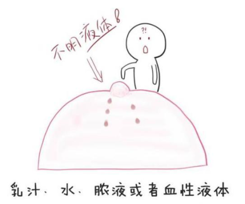 孕期乳头流  第1张
