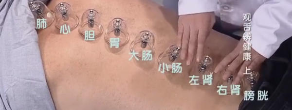 孕期能拔罐(孕期能拔罐) 第1张 孕期能拔罐(孕期能拔罐) 第1张