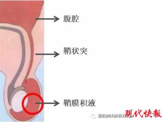 宝宝的两个蛋蛋竟然不一样大怎么办呢,胎儿睾丸有积液是怎么回事 第1张 宝宝的两个蛋蛋竟然不一样大怎么办呢,胎儿睾丸有积液是怎么回事 第1张