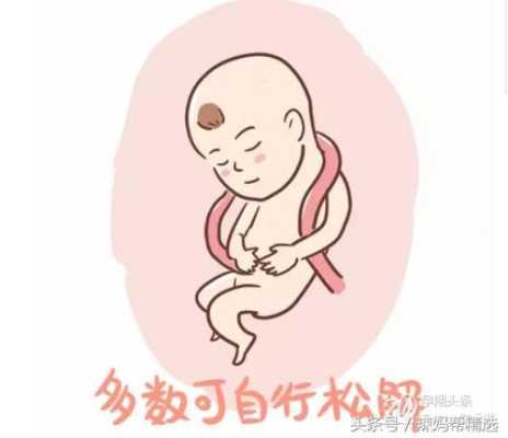 宝宝脐带上的绳子是什么,胎儿脐带绕颈二周怎么纠正  第3张
