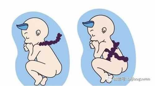 孕妇检查发现胎儿脐带绕颈怎么办,胎儿绕颈w是什么意思 第2张 孕妇检查发现胎儿脐带绕颈怎么办,胎儿绕颈w是什么意思 第2张