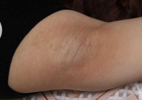孕期腋臭(孕期腋臭) 第1张 孕期腋臭(孕期腋臭) 第1张