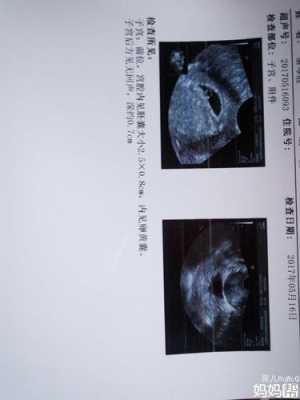 孕期彩超图(孕期彩超图片) 第1张 孕期彩超图(孕期彩超图片) 第1张