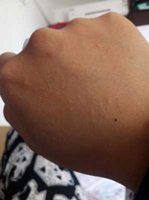 孕期长肉疙瘩（怀孕36周，手背胳膊腿上发痒一挠就起小疙瘩，怎么回事）  第1张