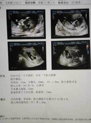 孕13周胎儿图片(13周是几个月怎么计算) 第3张 孕13周胎儿图片(13周是几个月怎么计算) 第3张