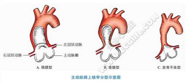 胎儿主动脉狭窄能要吗(什么是主动脉狭窄) 第2张 胎儿主动脉狭窄能要吗(什么是主动脉狭窄) 第2张