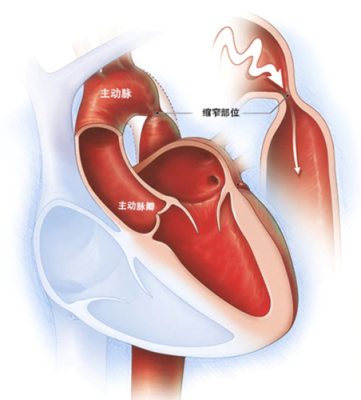 胎儿主动脉狭窄能要吗(什么是主动脉狭窄) 第1张 胎儿主动脉狭窄能要吗(什么是主动脉狭窄) 第1张