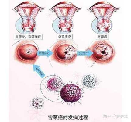 孕期宫颈疼(宫颈口痛是怎么回事) 第2张 孕期宫颈疼(宫颈口痛是怎么回事) 第2张