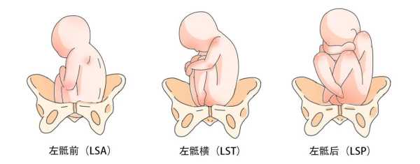 胎儿lsa(胎儿lsa) 第1张 胎儿lsa(胎儿lsa) 第1张