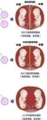 胎儿带羊膜(双胞胎胎儿之间有隔膜) 第1张 胎儿带羊膜(双胞胎胎儿之间有隔膜) 第1张