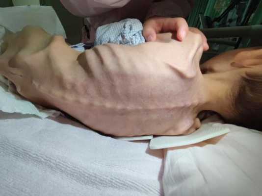 为什么一岁4个月的宝宝喝奶粉越来越瘦,皮包骨是什么原因,孕妇瘦了胎儿会瘦吗 第2张 为什么一岁4个月的宝宝喝奶粉越来越瘦,皮包骨是什么原因,孕妇瘦了胎儿会瘦吗 第2张
