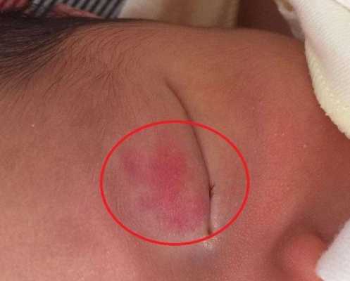孕妇怎样防止孩子有胎记,怎么预防胎儿长胎记的方法 第2张 孕妇怎样防止孩子有胎记,怎么预防胎儿长胎记的方法 第2张