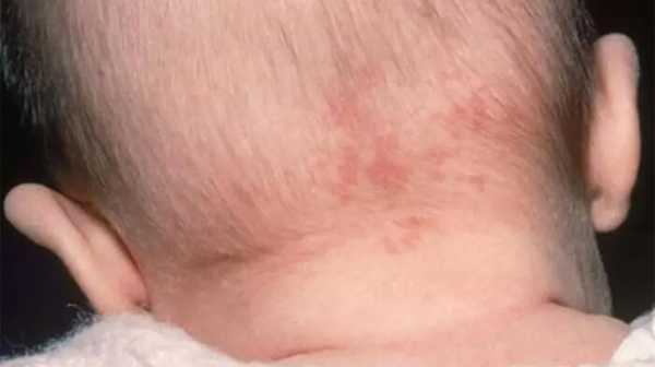 孕妇怎样防止孩子有胎记,怎么预防胎儿长胎记的方法 第1张 孕妇怎样防止孩子有胎记,怎么预防胎儿长胎记的方法 第1张