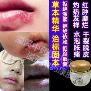 孕期嘴巴上火起泡怎么办(上火嘴唇起泡吃什么药好) 第3张 孕期嘴巴上火起泡怎么办(上火嘴唇起泡吃什么药好) 第3张