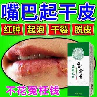 孕期嘴巴上火起泡怎么办(上火嘴唇起泡吃什么药好) 第2张 孕期嘴巴上火起泡怎么办(上火嘴唇起泡吃什么药好) 第2张