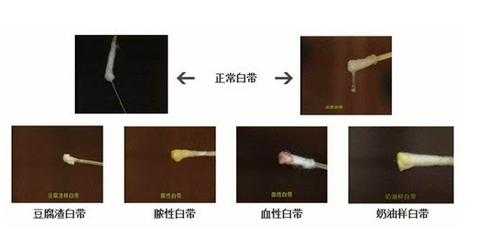 孕期白带发黄是什么原因(孕期分泌物颜色对照表) 第2张 孕期白带发黄是什么原因(孕期分泌物颜色对照表) 第2张