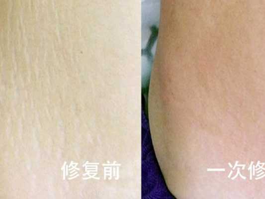 孕期长妊娠纹痒怎么办(孕妇妊娠纹痒可以涂炉甘石吗) 第1张 孕期长妊娠纹痒怎么办(孕妇妊娠纹痒可以涂炉甘石吗) 第1张