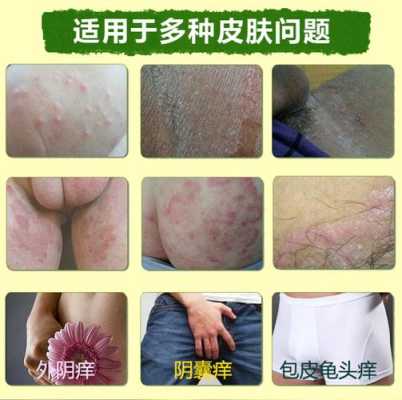 怀孕后外阴瘙痒咋回事?怎么办,孕妇下面痒会影响胎儿吗 第2张 怀孕后外阴瘙痒咋回事?怎么办,孕妇下面痒会影响胎儿吗 第2张