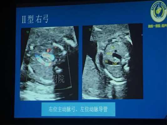 胎儿主动脉弓分支变异(胎儿主动脉弓分叉) 第1张 胎儿主动脉弓分支变异(胎儿主动脉弓分叉) 第1张