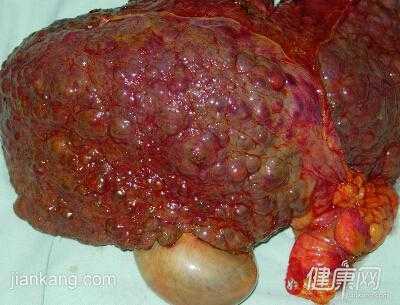 胎儿肝畸形(肝血管瘤会癌变吗) 第1张 胎儿肝畸形(肝血管瘤会癌变吗) 第1张