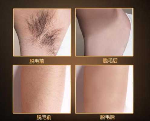 孕期激光脱毛(孕期激光脱毛对胎儿有影响吗) 第3张 孕期激光脱毛(孕期激光脱毛对胎儿有影响吗) 第3张