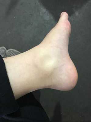 孕妇六个月脚肿是什么原因?这是什么情况啊,孕期脚踝肿是什么原因引起的 第2张 孕妇六个月脚肿是什么原因?这是什么情况啊,孕期脚踝肿是什么原因引起的 第2张