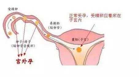 孕期右下腹部隐痛的原因(孕期右下腹部隐痛的原因有哪些) 第2张 孕期右下腹部隐痛的原因(孕期右下腹部隐痛的原因有哪些) 第2张