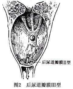 孕中期总感觉胎动已到尿道口是为什么,胎儿后尿道瓣膜是什么原因造成的 第2张 孕中期总感觉胎动已到尿道口是为什么,胎儿后尿道瓣膜是什么原因造成的 第2张