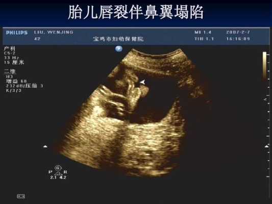 胎儿有唇裂(什么是胎梦) 第2张 胎儿有唇裂(什么是胎梦) 第2张