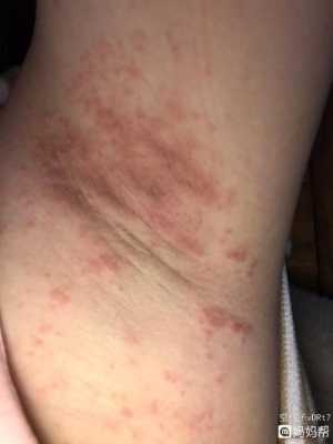 孕期腋下痒(孕期腋下痒怎么回事) 第2张 孕期腋下痒(孕期腋下痒怎么回事) 第2张