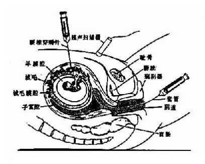 抽胎儿绒毛(抽取胎儿绒毛怎样抽取) 第2张 抽胎儿绒毛(抽取胎儿绒毛怎样抽取) 第2张