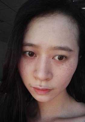 孕期蝴蝶斑（孕期蝴蝶斑产后会消失吗）  第3张