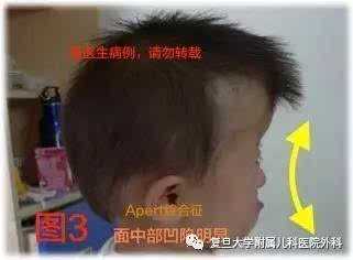 婴儿什么时候长大脑,胎儿小脑发育不良是什么原因造成的 第2张 婴儿什么时候长大脑,胎儿小脑发育不良是什么原因造成的 第2张